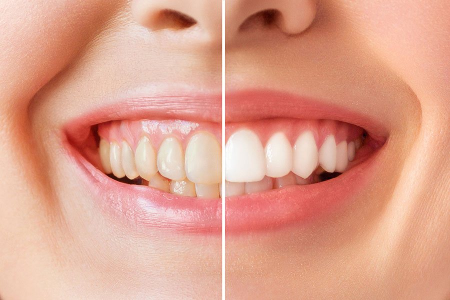 before and after teeth smile